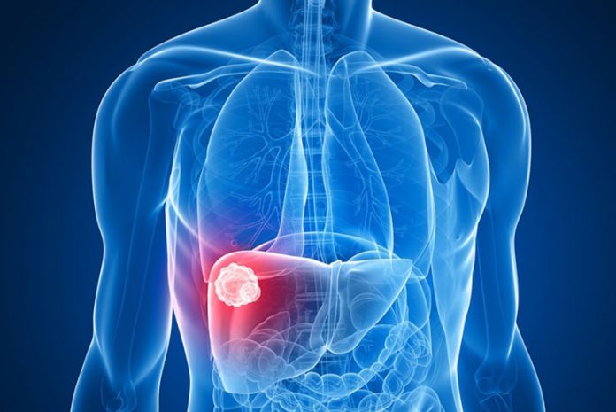 ac-liver-cancer-insert-02