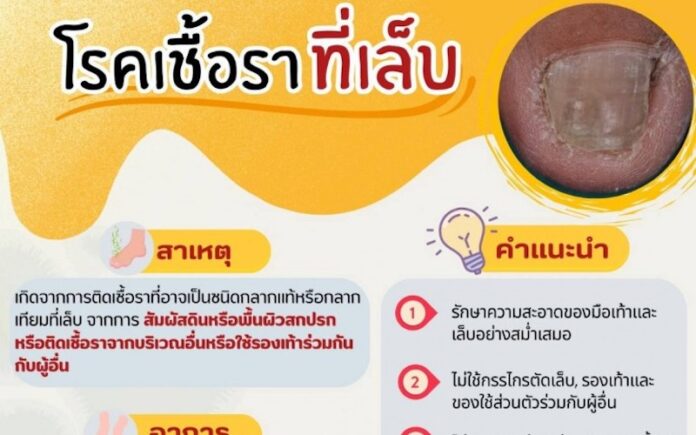 โรคเชื้อราที่เล็บ