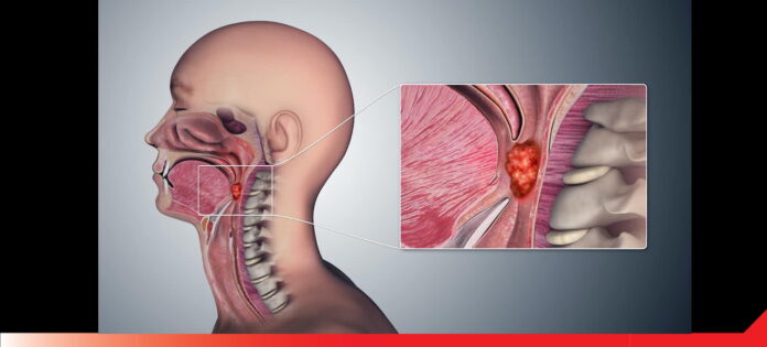 Cancer ารมีเพศสัมพันธ์ทางปากอาจเป็นหนึ่งในสาเหตุหลัก ของมะเร็งลำคอ